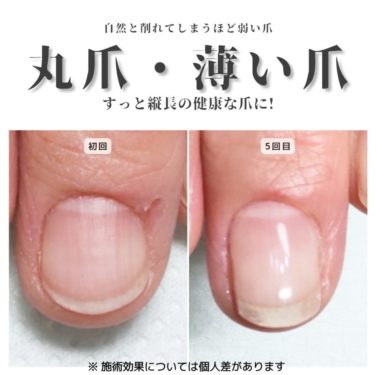 まる爪・薄い爪